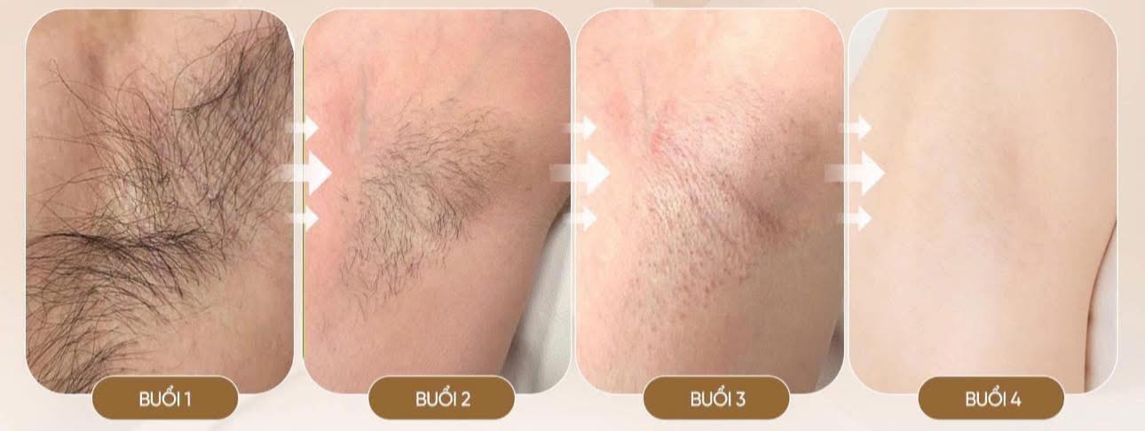 Ni Spa cung cấp dịch vụ triệt lông, gội đầu dưỡng sinh, massage trị liệu, chăm sóc và phục hồi da tại Vinhome Grand Park, HCM.